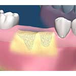 Bone Grafting