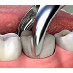 Tooth Extraction